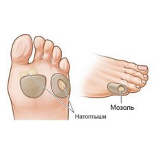 Удаление мозолей и натоптышей